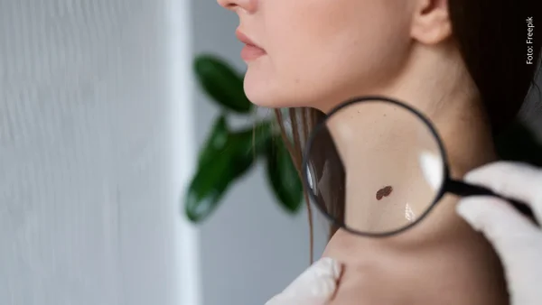 ¿Qué es el melanoma, la enfermedad que enfrenta la hija de John Mellencamp? ¿Qué es el melanoma, la enfermedad que enfrenta la hija de John Mellencamp?