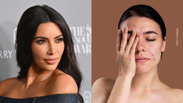 ¿Qué es la psoriasis?, enfermedad que sufre Kim Kardashian