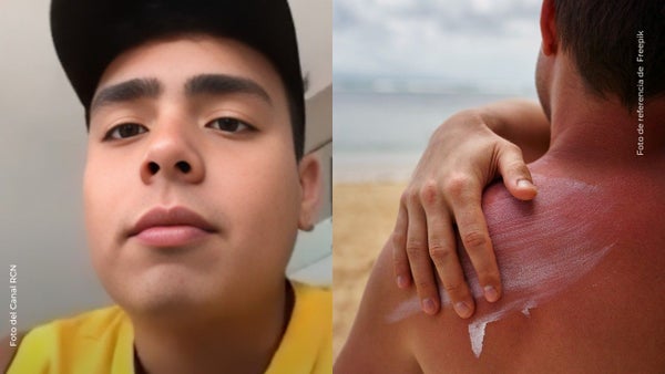 Felipe Saruma enseñó la verdad detrás de sus fuertes ‘quemaduras de sol’