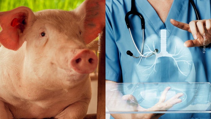 Hombre recibe un pulmón de cerdo en China Un pulmón de cerdo fue trasplantado en un humano