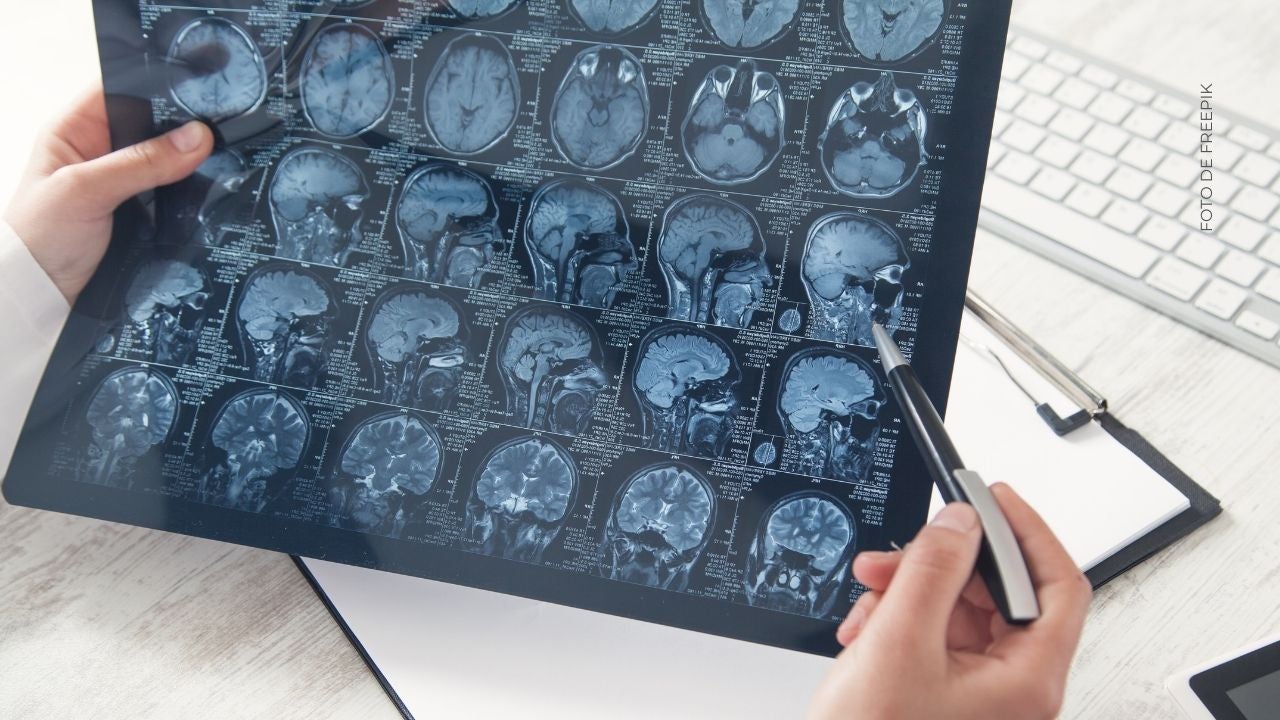 ¿Qué es un accidente cerebrovascular?