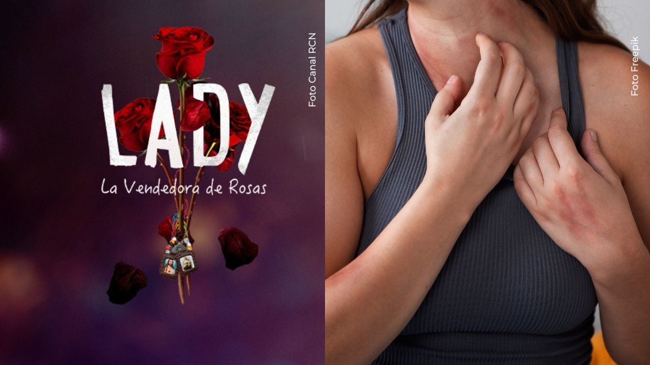 Michell Orozco preocupa al mostrar enfermedad en la piel que tiene