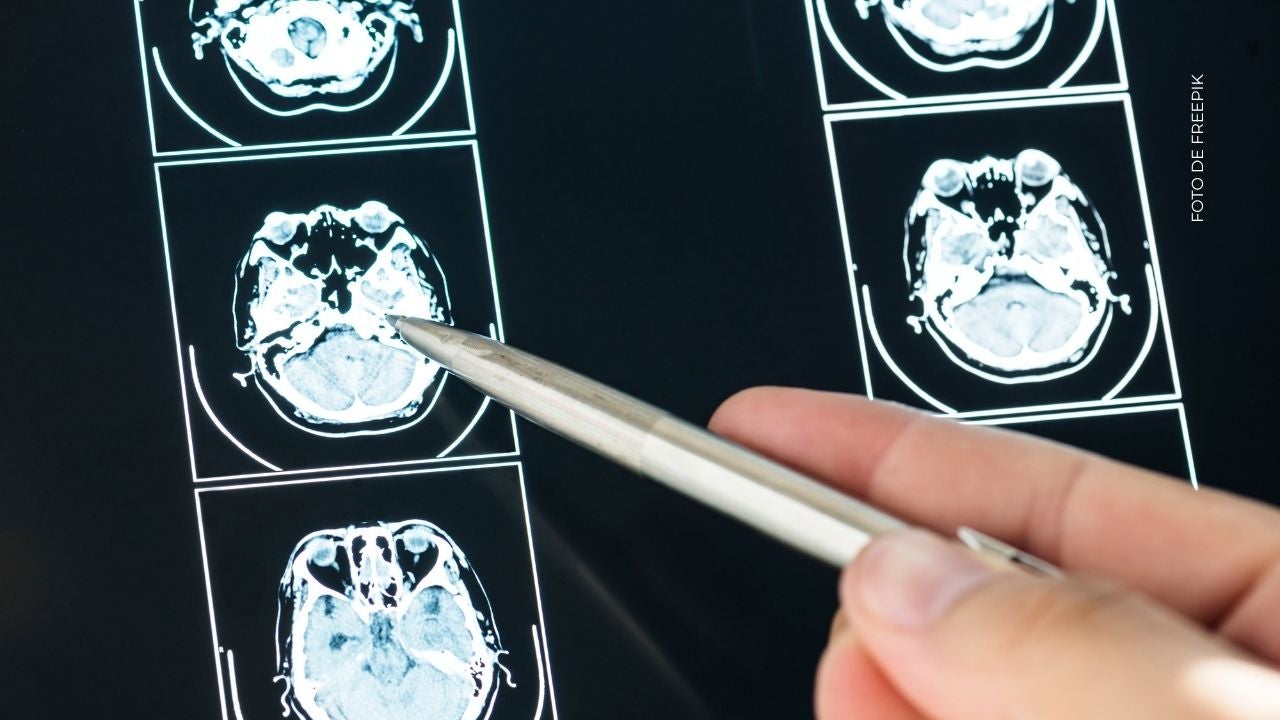 ¿Qué es un aneurisma cerebral?