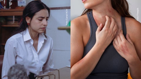 Michell Orozco se sinceró sobre su enfermedad en la piel