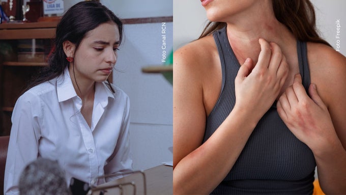 Michell Orozco Michell Orozco se sinceró sobre su enfermedad en la piel