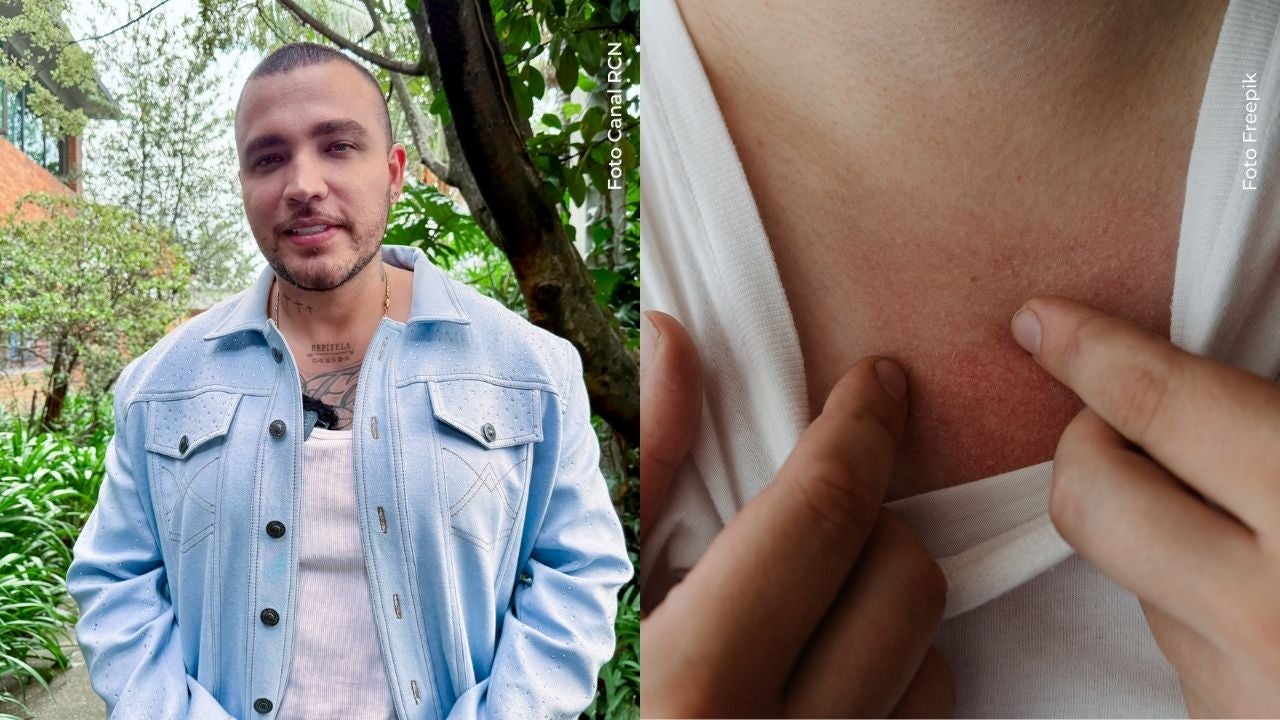 Jessi Uribe se sinceró sobre enfermedad en la piel