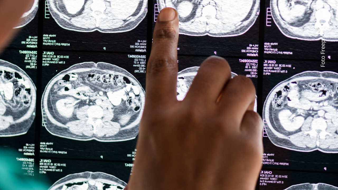 Cambios en la personalidad o dificultad para leer, señales poco obvias que podrían alertar sobre un tumor cerebral.