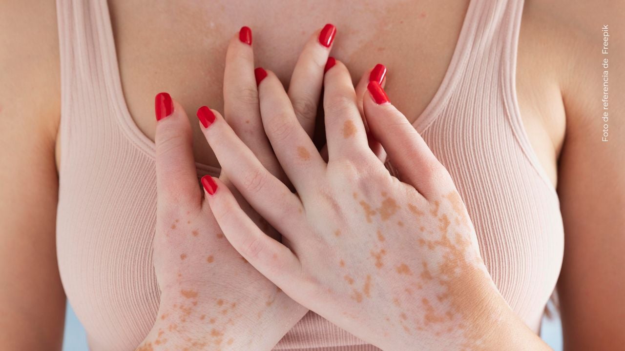 El antes y después del vitíligo de la esposa de Carlos Feria genera reacciones