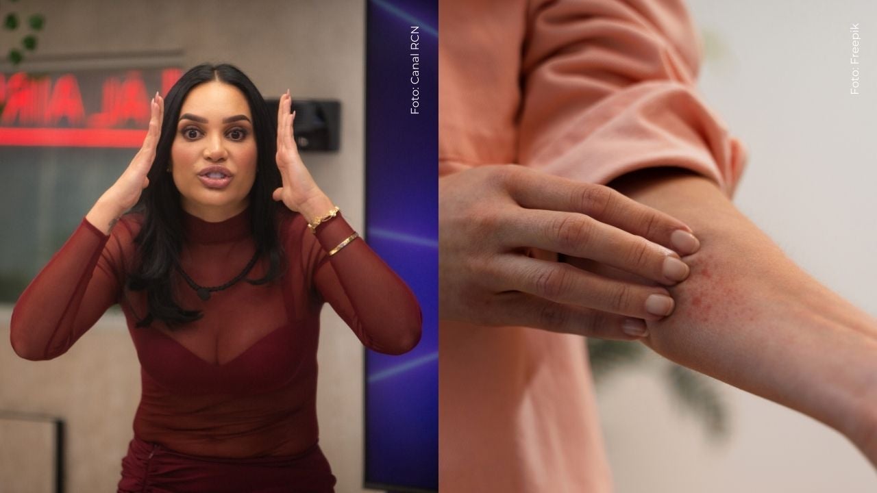 Andrea Valdiri habla sobre la enfermedad que padece tras mostrar su cuerpo lleno de alergia
