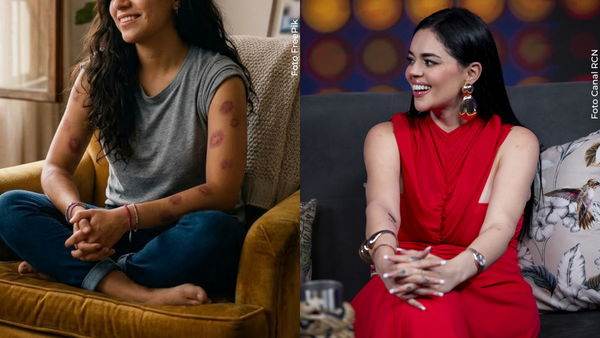 La Segura apareció con curiosas marcas en sus brazos y reveló quién se los hizo: no fue su esposo