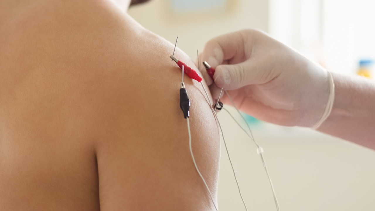 ¿De dónde viene la acupuntura?