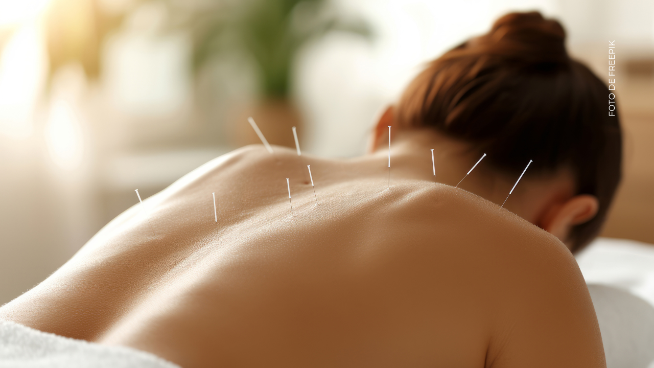 ¿Qué beneficios tiene la acupuntura?
