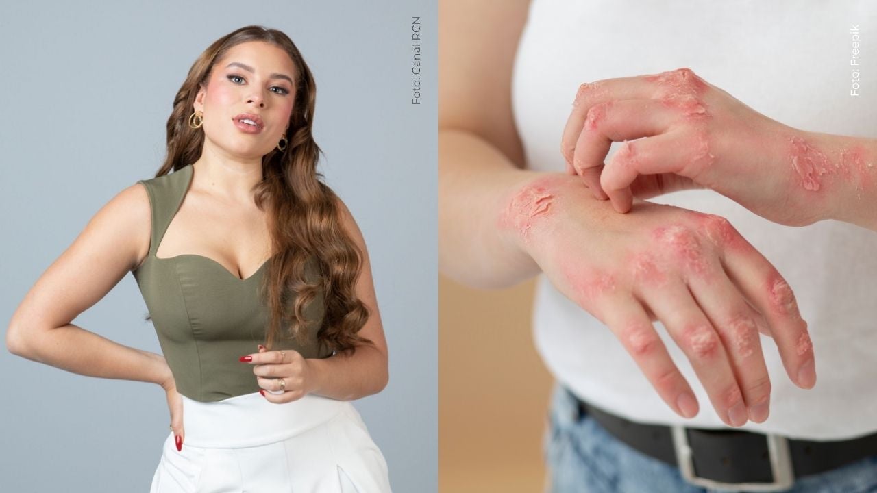 Ornella Sierra reveló que padece psoriasis y habló de cómo vive con esta enfermedad