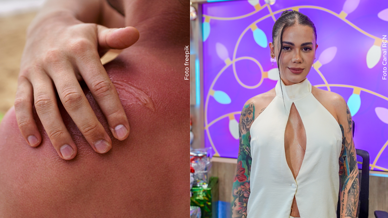 Cintia Cossio preocupó al mostrar cómo quedó su piel tras quemarse con el sol